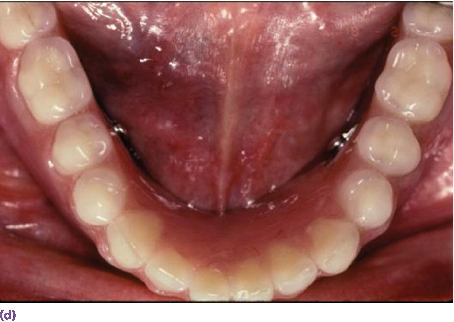 Photo displaying cameo view of suprastructure of milled bar overdenture with complete teeth in mandible part.