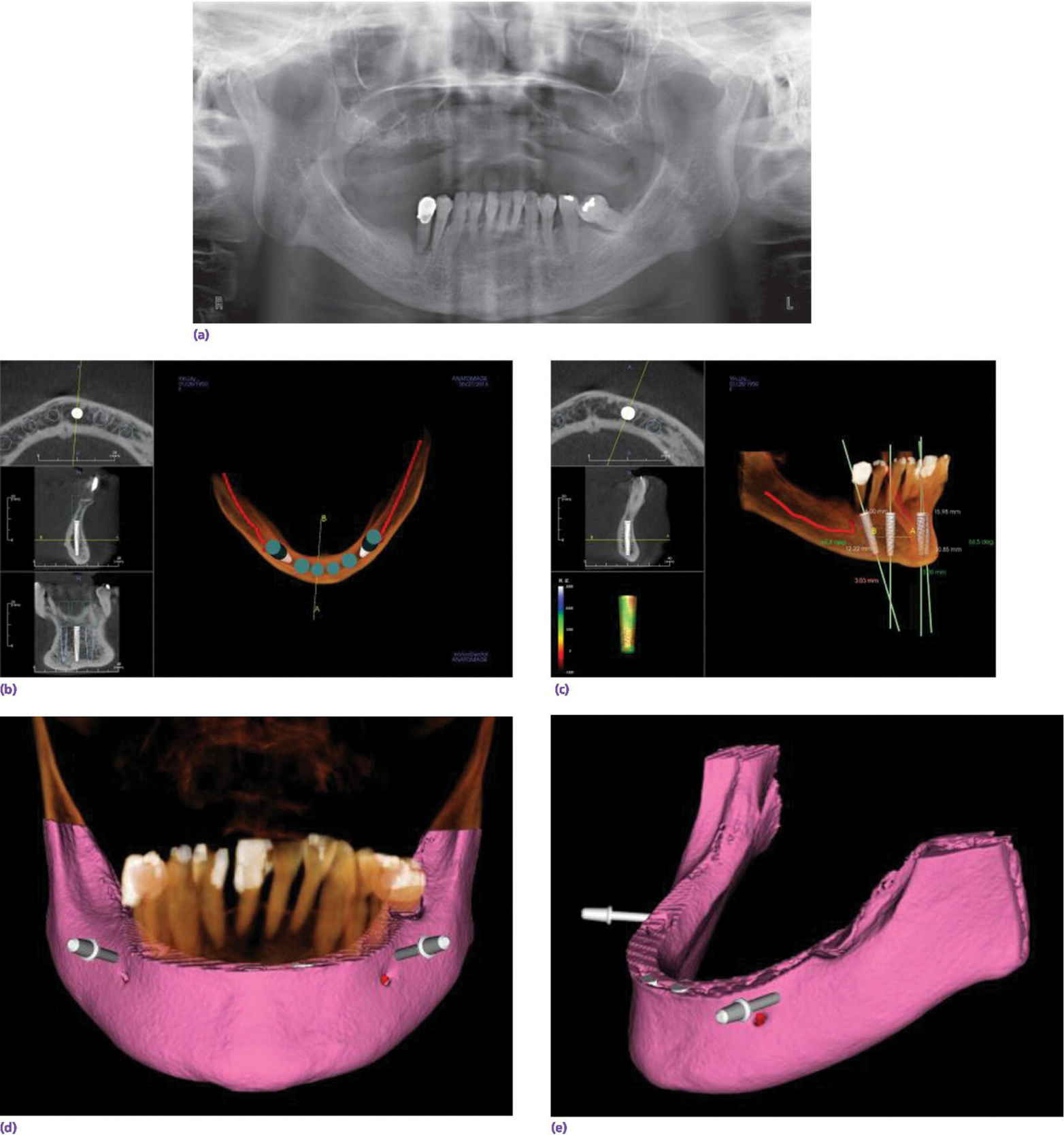 Radiograph displaying preoperative orthopantomogram of edentulous maxilla and terminal mandibular dentition.