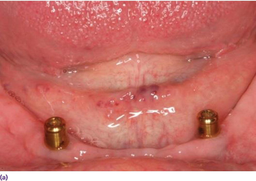 Photo displaying two-implant solitary anchor design (LocatorR) for overdenture.