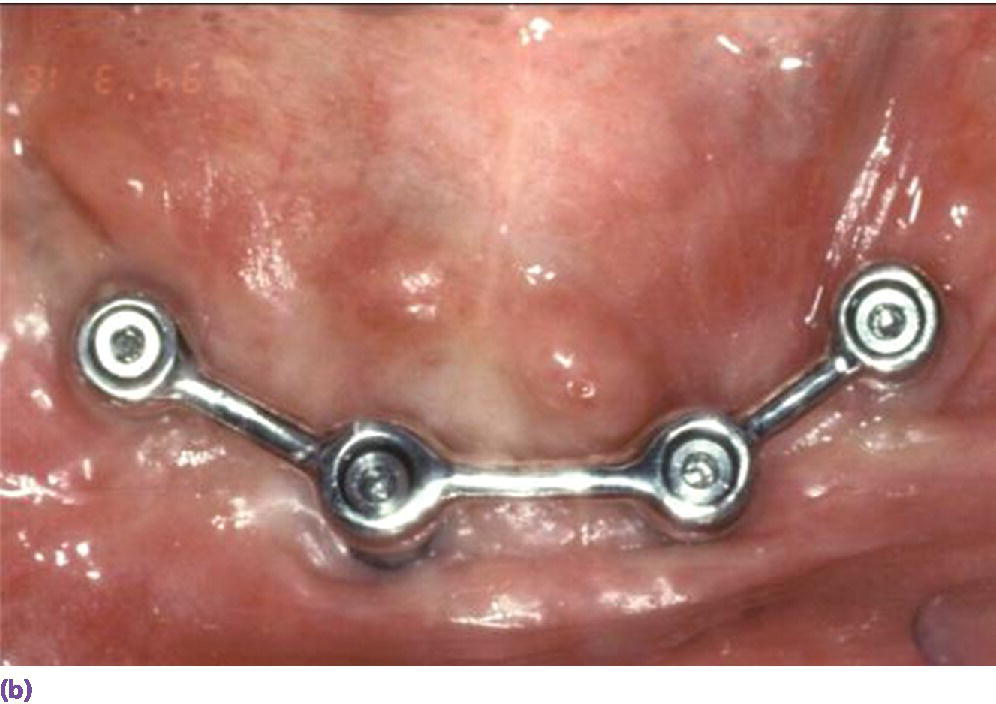 Photo displaying four-implant splinted bar design for overdenture.