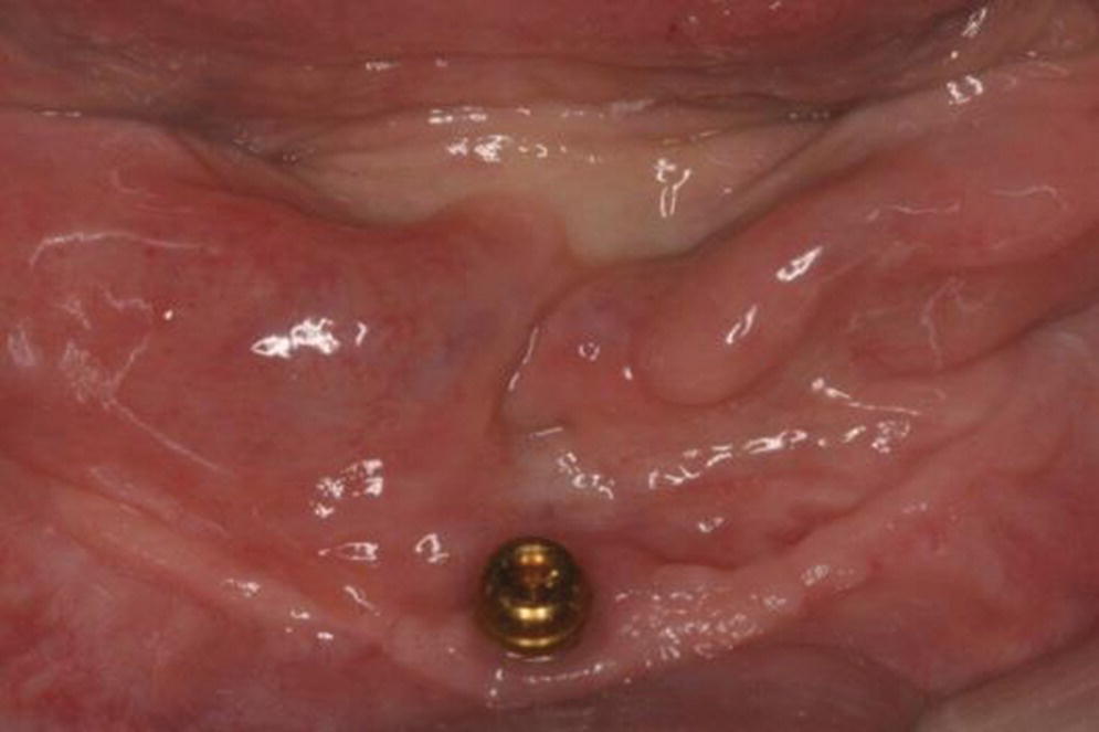 Photo displaying single symphyseal design (LocatorR) for overdenture.