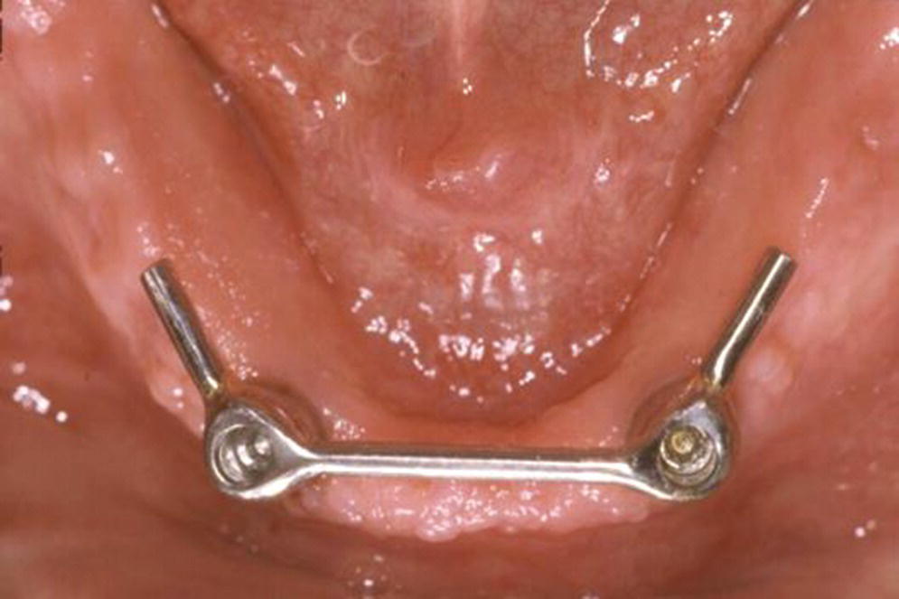 Photo displaying two‐implant splinted bar design with distal cantilever extensions.