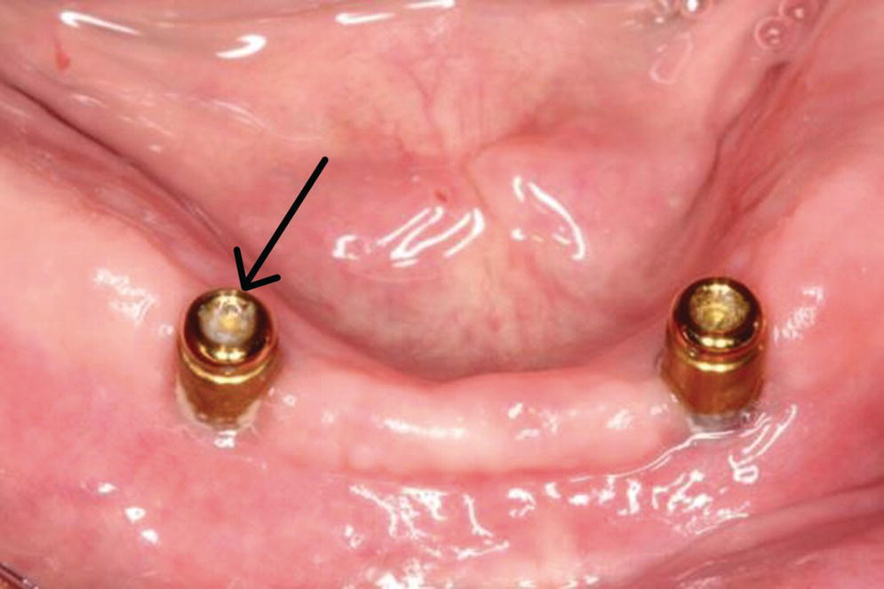 Photo displaying two abutments implanted with distant with arrow pointing to left abutment denoting food impaction disclosed in internal well of the Locator abutment.
