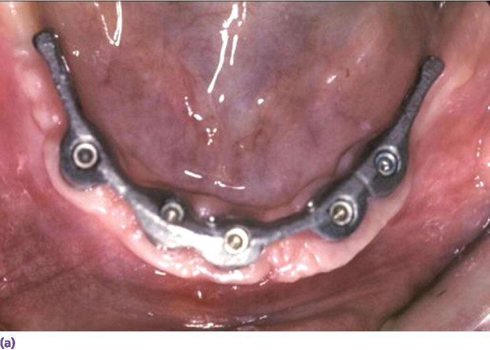 Photo displaying spark-eroded milled bar anchorage system in mandible part.