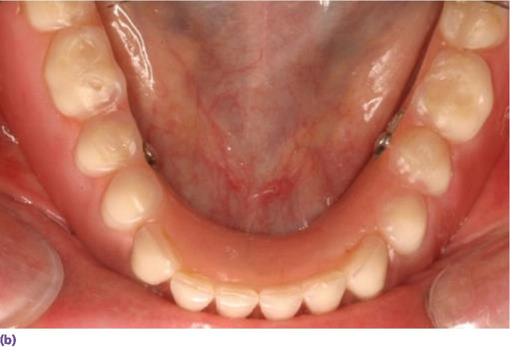 Photo displaying milled bar overdenture suprastructure with complete denture planted in mandible.