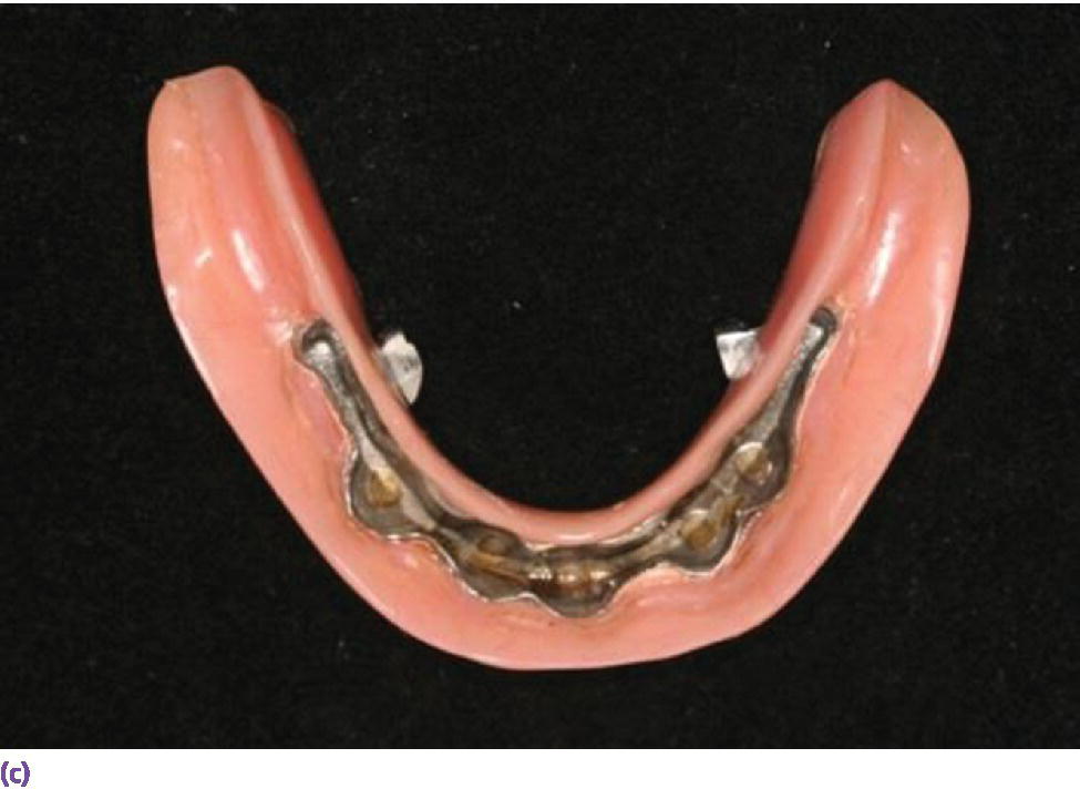 Photo displaying intaglio of milled bar overdenture suprastructure revealing secondary bar and reinforcement.