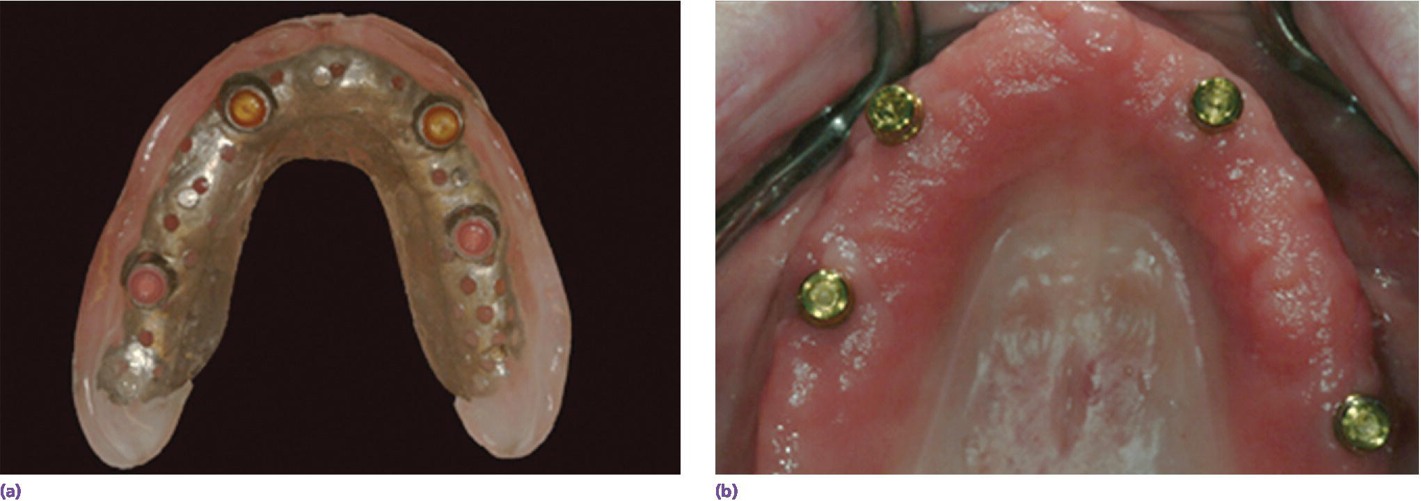 Photos of design of overdenture with reduced palatal coverage and metal-reinforced base (left) and stud abutments well spaced with potential for servicing (right).