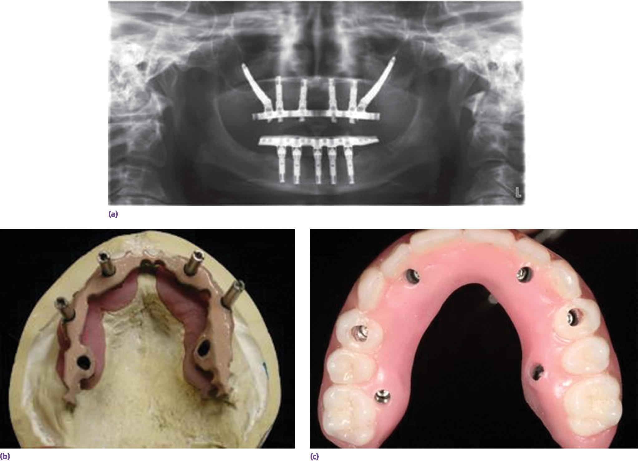 Radiograph of patient treated for anhidrotic ectodermal dysplasia and 10-year follow-up indicating servicing need with multiple acrylic tooth replacements (top). Photo of silicoated frameworks(bottom).