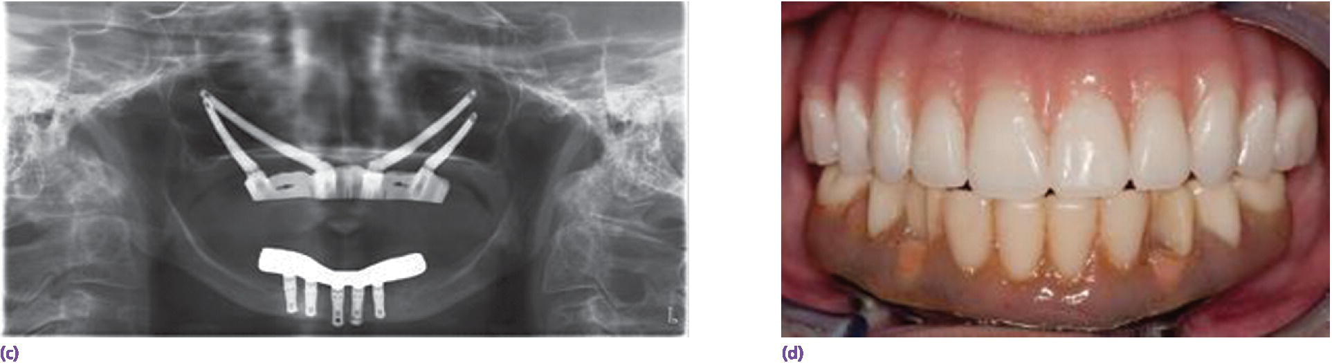 Radiograph of subsequent bar attachment (left) and Photo of clinical view with precision-fit electrical-discharged machined metal-based overdenture(right).