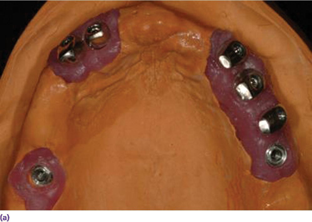 Photo displaying telescopic abutment design for angle correction and auxiliary screw retention on posterior implants.