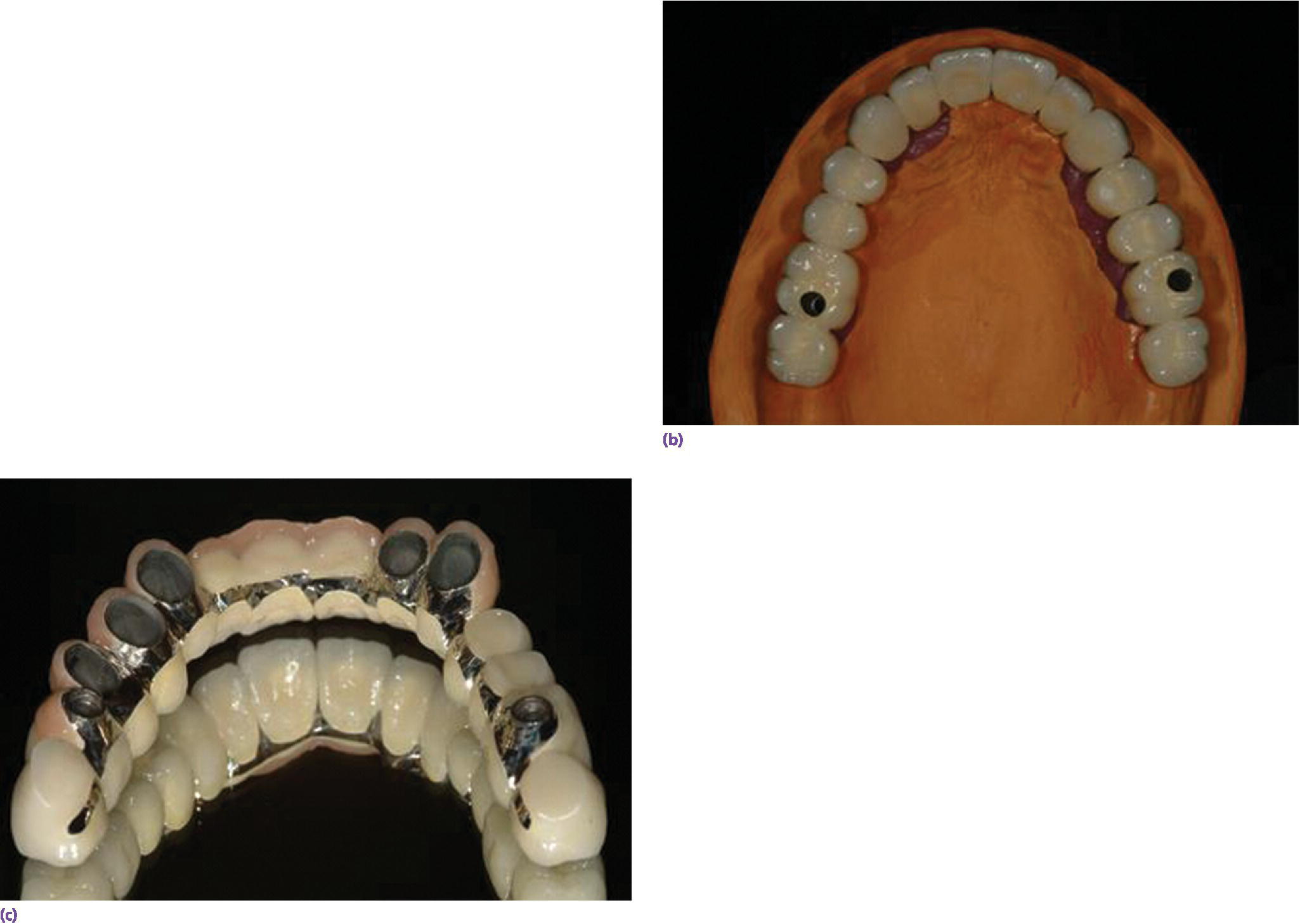 Photos of metal–ceramic design with cross arch splinting (top right) and intaglio of prosthesis with telescopic retainers and direct-to-fixture screw connections (bottom left).