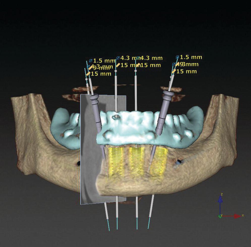 Screenshot of planning for implant surgery accomplished with Nobel clinician protocol with radiographic 3D template is milles, identical in morphology, replica of digital provisional denture