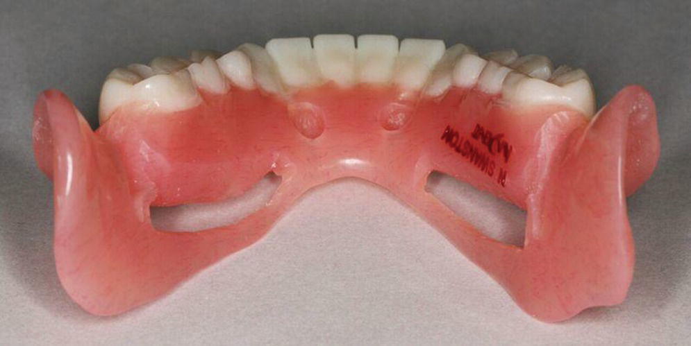 Photo displaying milled coversion denture with slots and recess to allow easy placement with connection to temporary copings for conversion to provisional fixed complete denture.