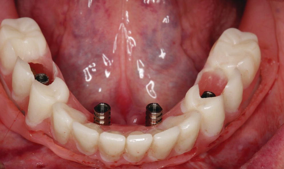 Photo displaying mandibular denture on soft tissues with holes utilizing information from digital planning for surgery with periphery struts for easy separation.