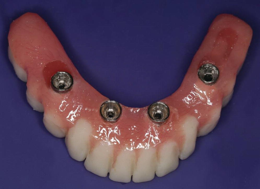 Photo displaying intaglio surface of mandibular conversion denture