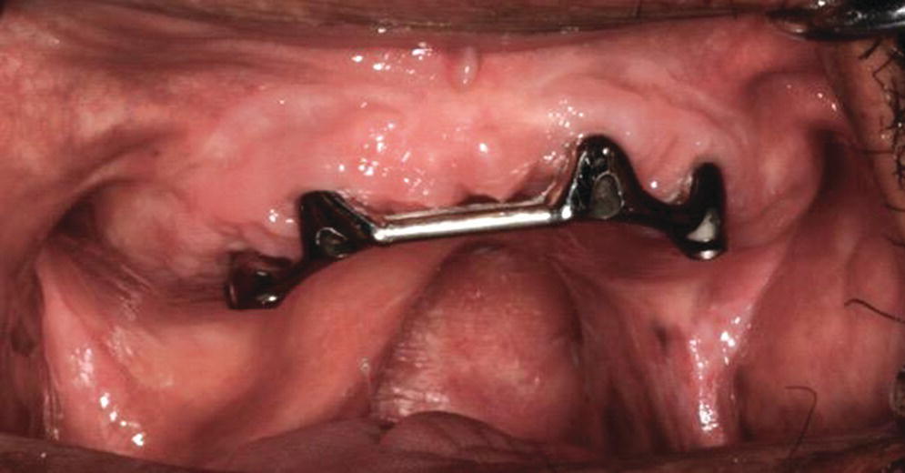 Photo displaying implant connecting bar used to retain a complete denture and soft palate obturator in a patient with a soft palate defect.