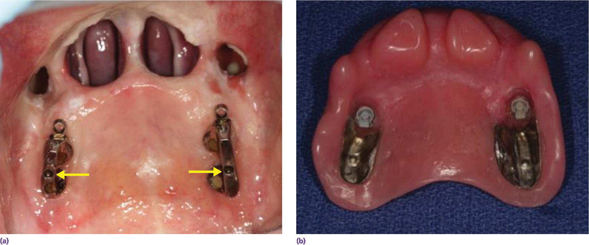 2 photos displaying a typical defect restored with implants: (a) implants connecting bar and (b) definitive prosthesis (c) prosthesis in position.