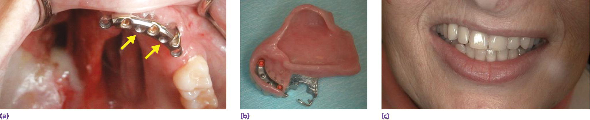3 photos of suggested implant connecting bar design used to retain overdentures with soft palate obturators: position of implants, anterior segment of implant connecting bar, and patient with soft palate defect.