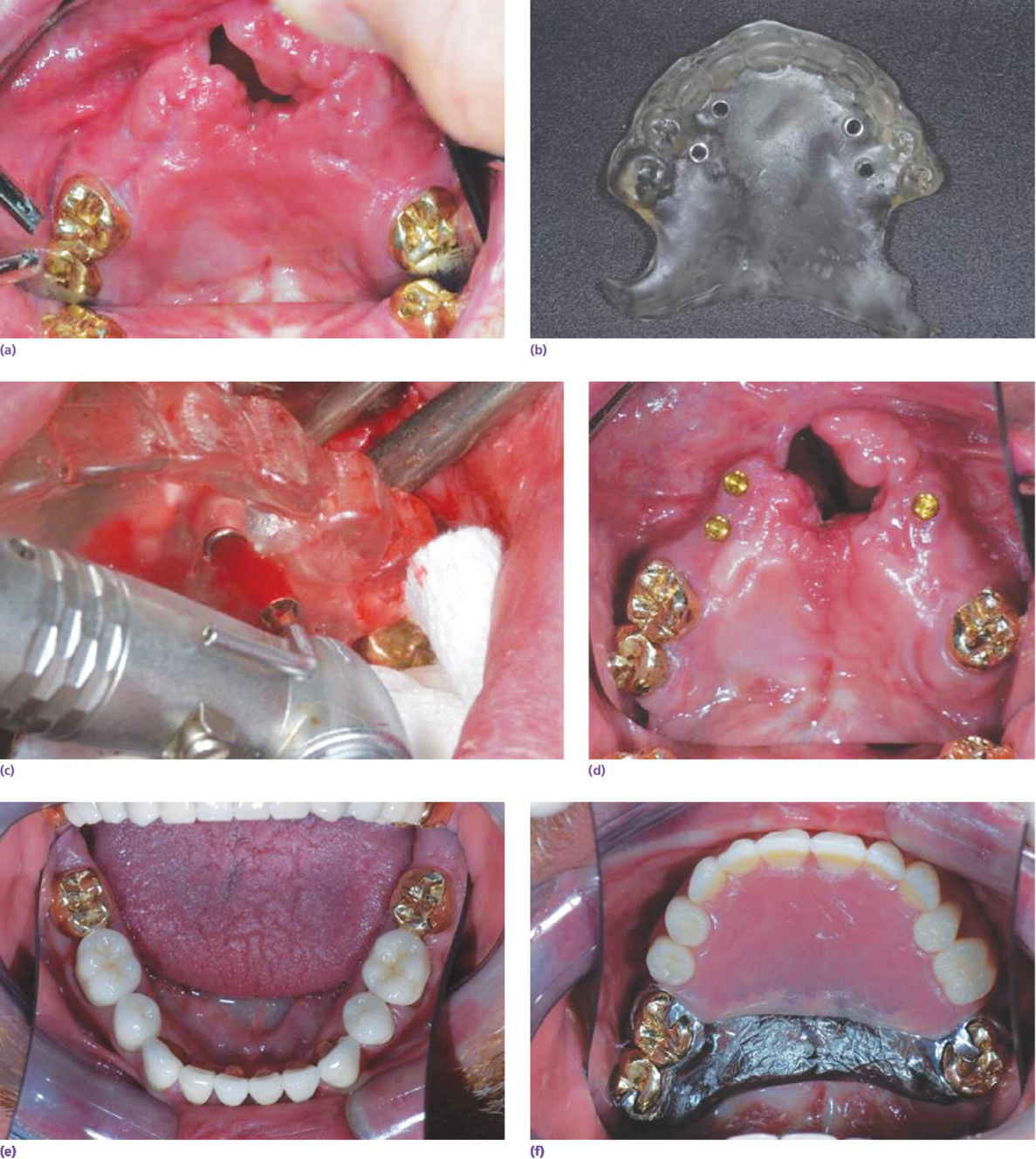 7 Photos of partially repaired cleft displaying surveyed crowns, surgical template, implant sites, implants in position, restored mandibular dentition, and completed overlay removable partial denture.