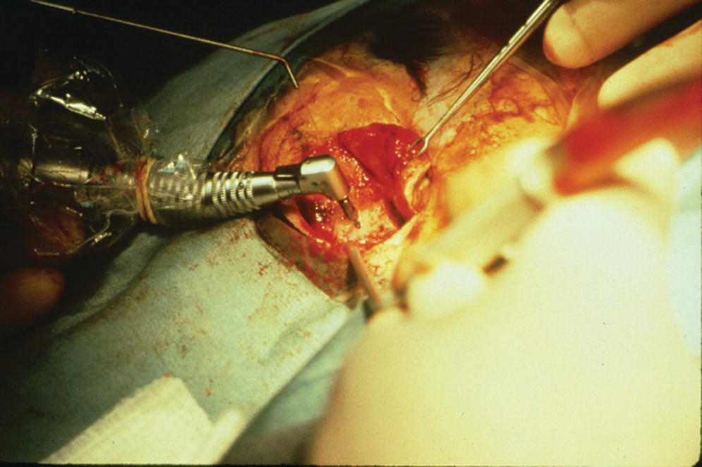 Photo displaying pilot holes for craniofacial implant sockets created with a
pilot drill.