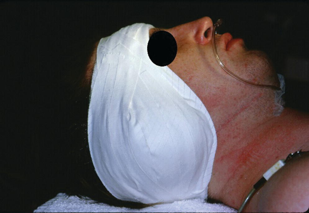 Photo displaying a patient with surgical dressing applied to maintain adaptation of the flap to the underlying bone for good attachment during the healing phase.