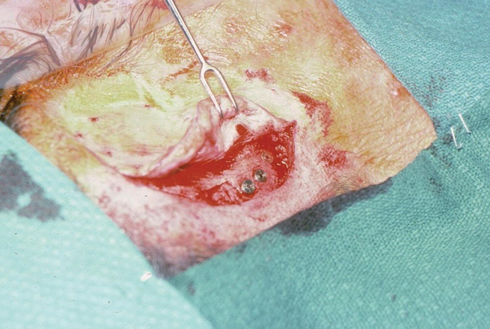 Photo displaying full-thickness flap being raised during second stage surgery wherein incision is made through the original site.