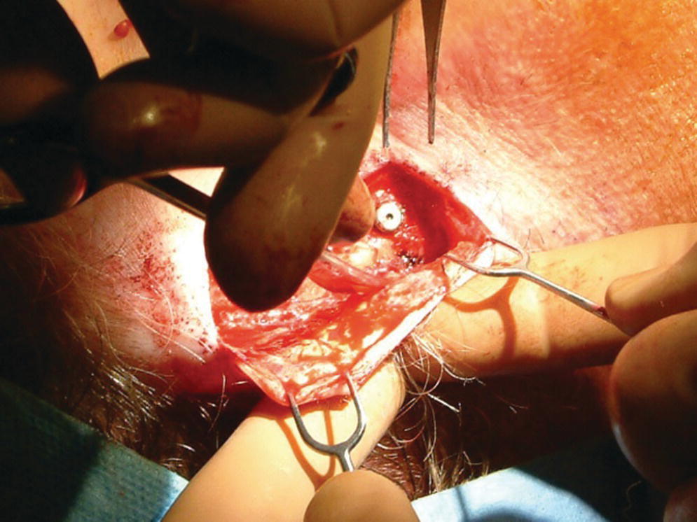 Photo illustrating the debulking of the full‐thickness flap.