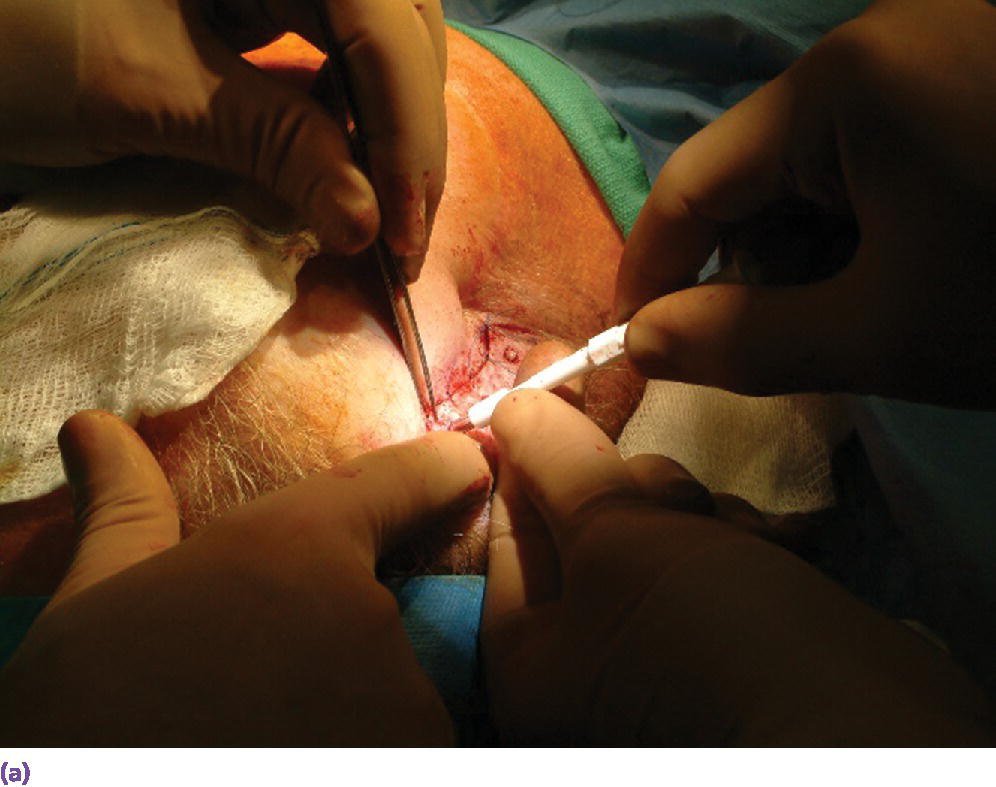 Photo displaying the debulked flap being repositioned and holes being created through the flap over the underlying craniofacial implants using a surgical punch.