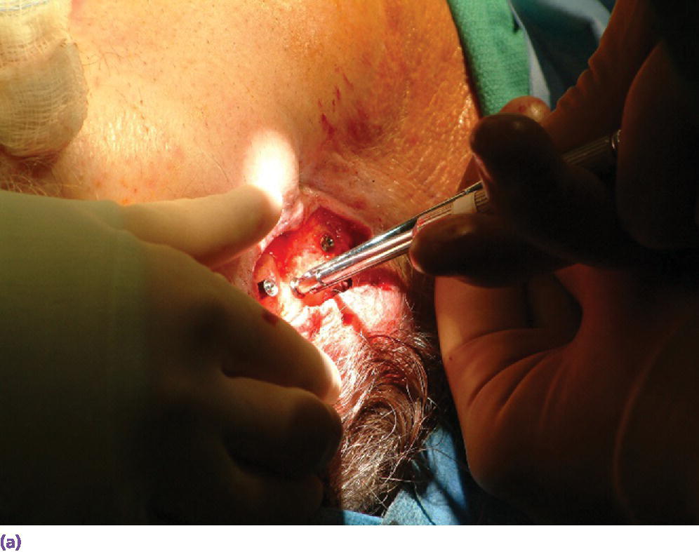 Photo displaying final abutments being secured to the craniofacial implants.