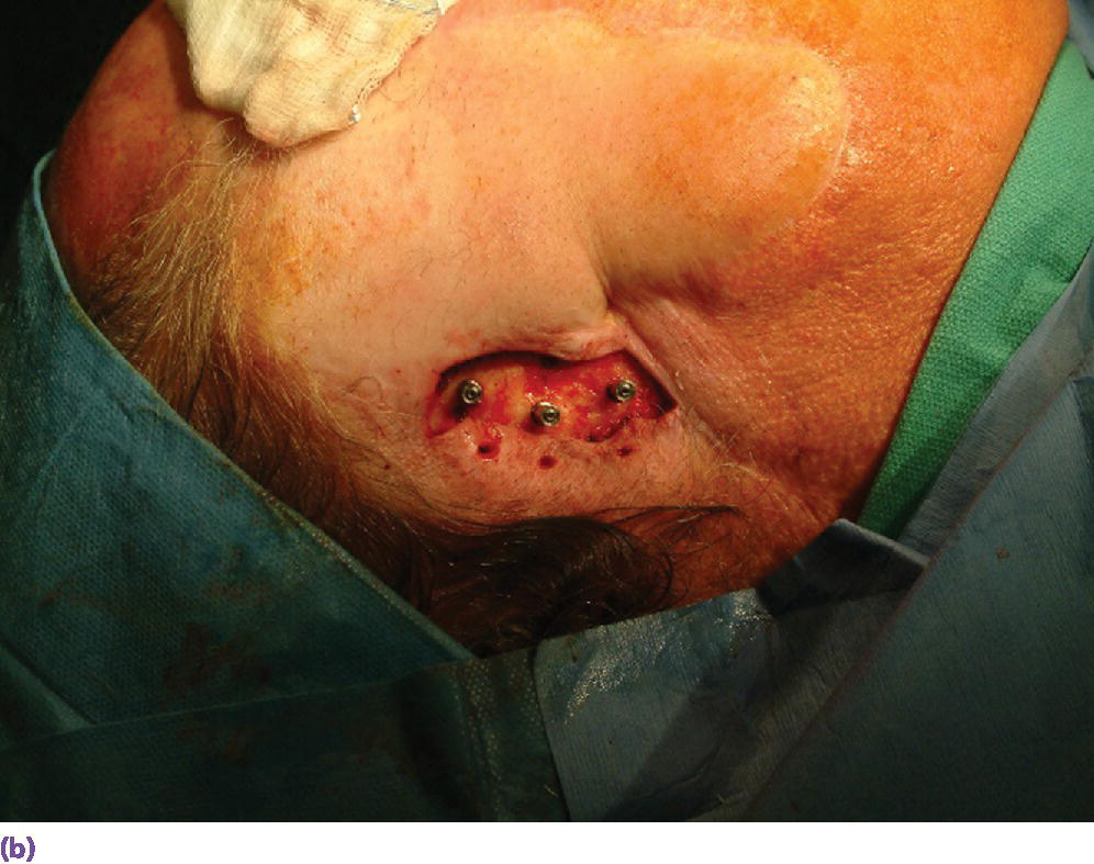 Photo displaying final abutments secured to their respective craniofacial implants.