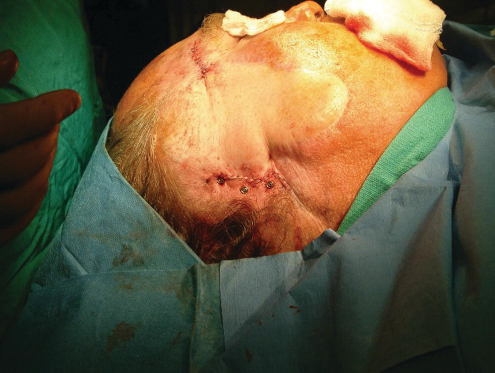 Photo displaying skin flap repositioned and sutured in place with abutments protrude at 1 mm through the skin.