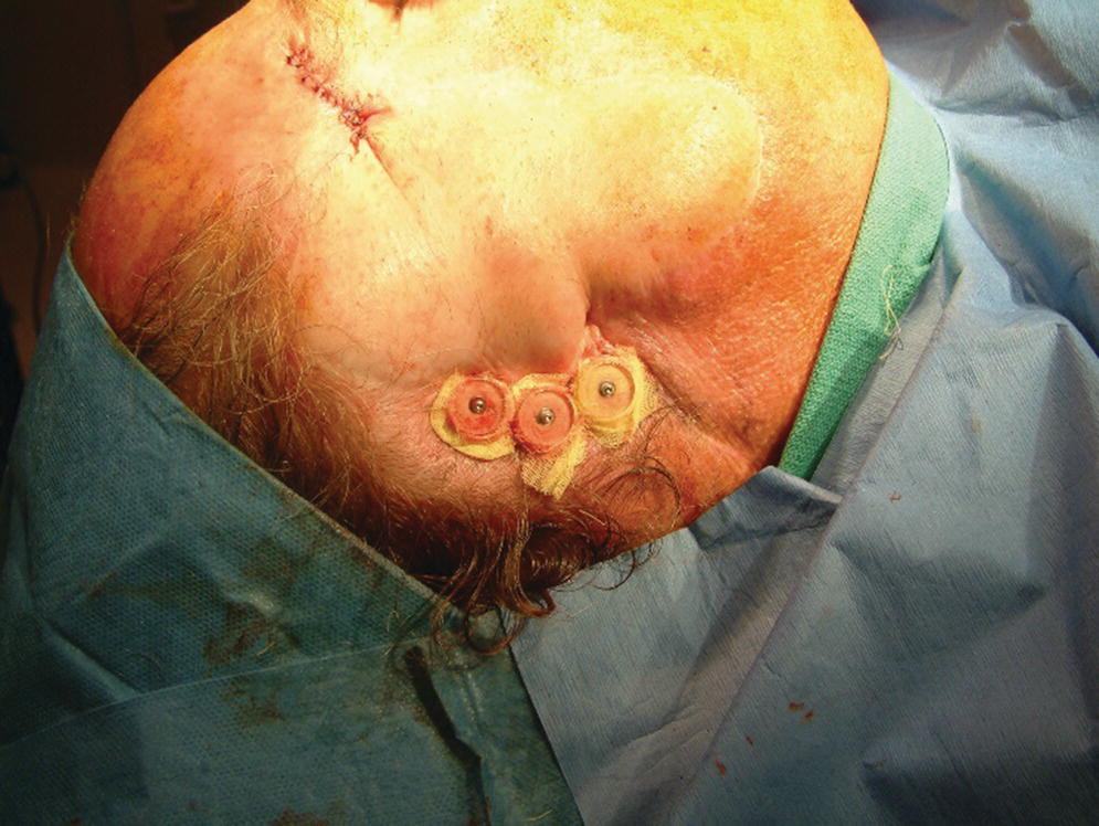 Photo displaying healing caps and surgical dressing applied around the abutments and skin flap.