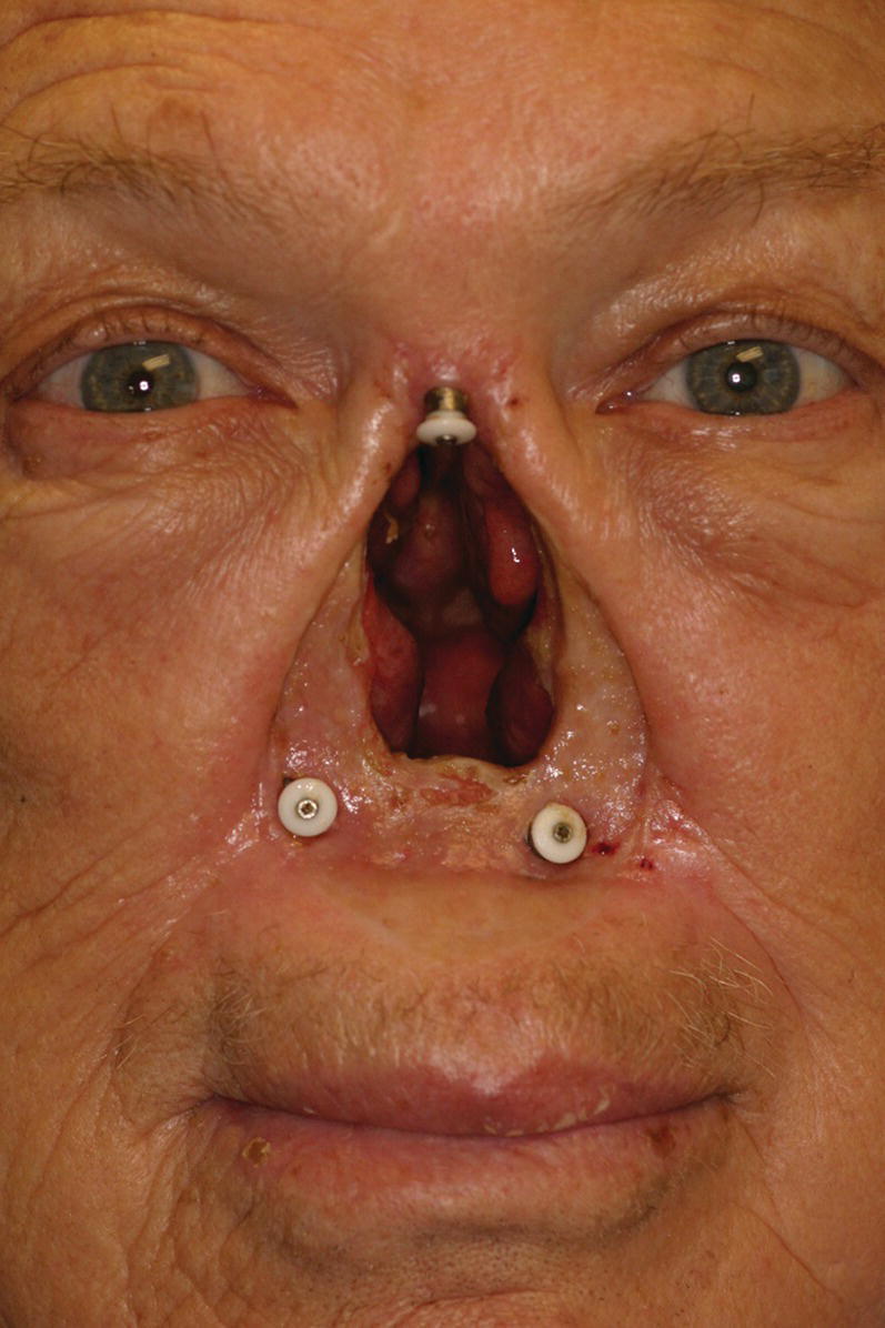 Photo displaying a patient with craniofacial implants placed in floor of nose and in glabella region.