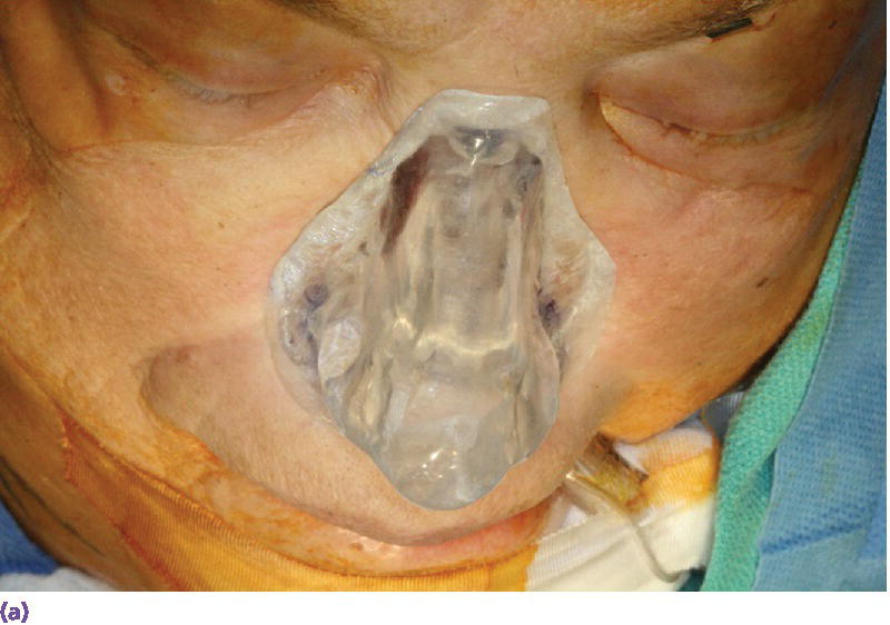 Photo displaying a patient with surgical nose template drilled through areas of radiographic markers.