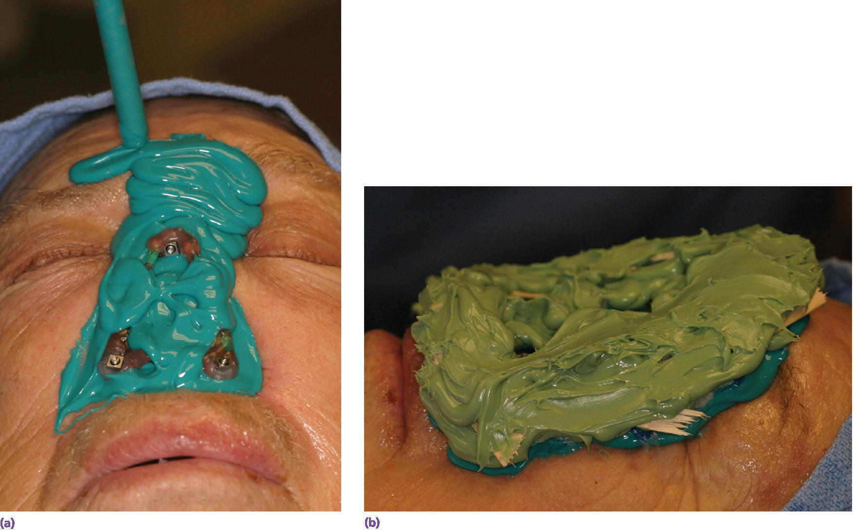 Two photos displaying moulage with pieces of tongue blades embedded within the high‐viscosity material.