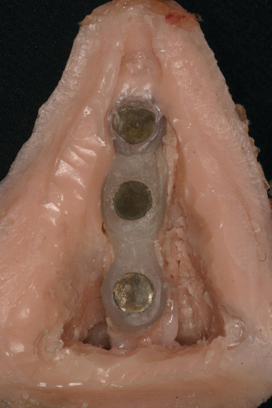 Photo displaying the acrylic resin superstructure framework, housing a matching
set of cobalt–samarium magnets, embedded within the final prosthesis.
