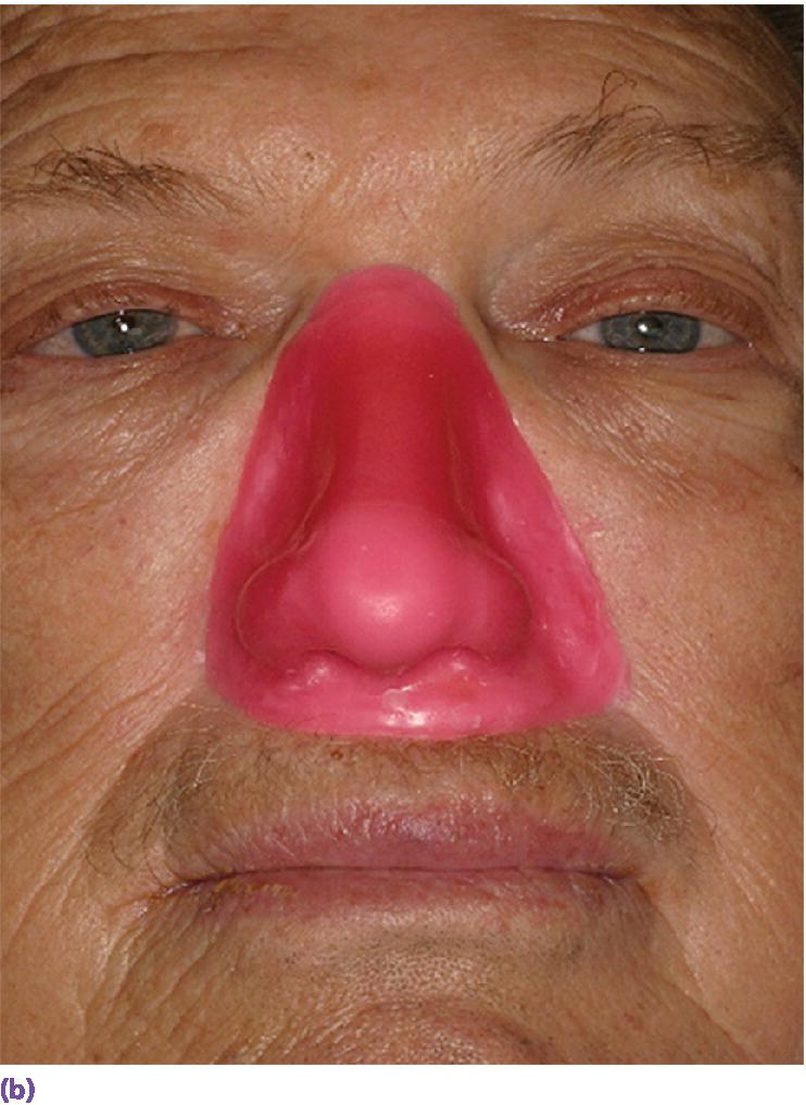 Photo displaying final wax pattern positioned on patient’s face.