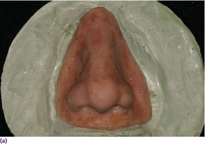 Photo displaying final nasal prosthesis on master cast.