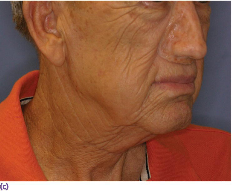 Photo displaying three-quarter view of final nasal prosthesis positioned on patient’s face.