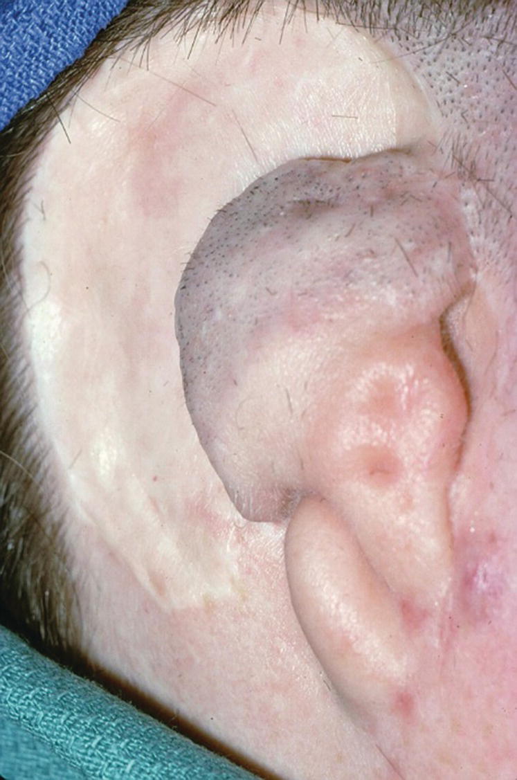 Closeup lateral view photo of a patient with congenital atresia of the right auricle.