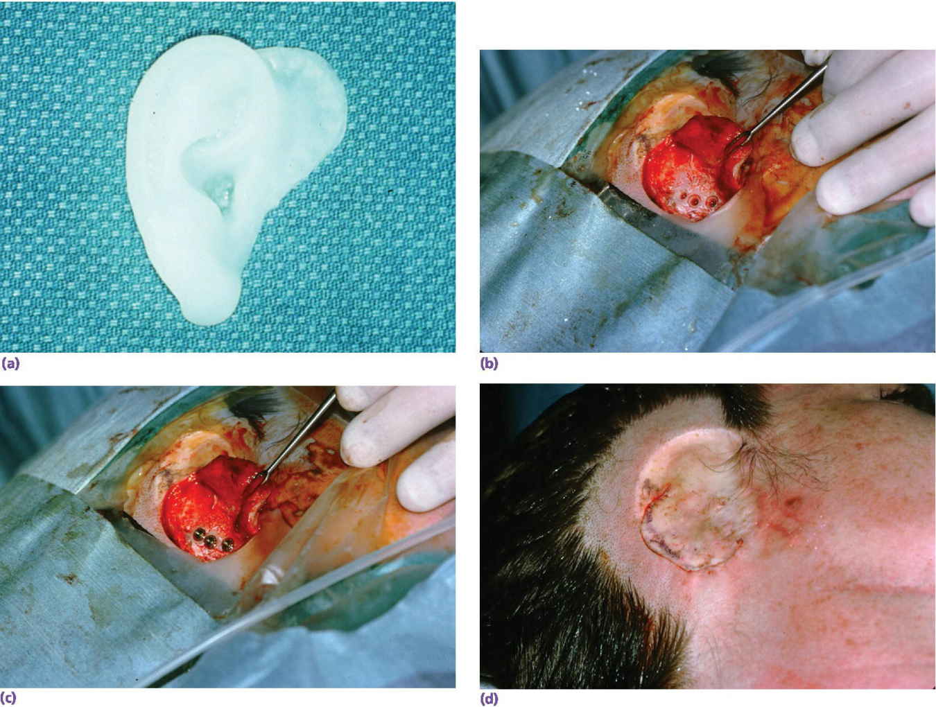 Four photos displaying surgical template, three implants placed with countersinking, abutments connected to implants, and surgical closure.