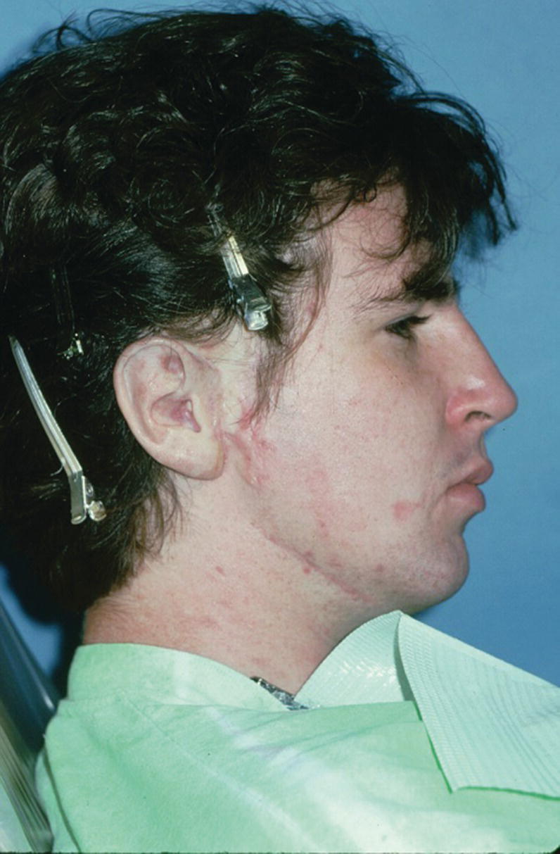 Photo displaying the patient with final auricular prosthesis cast, custom stained, and engaged onto implant framework.