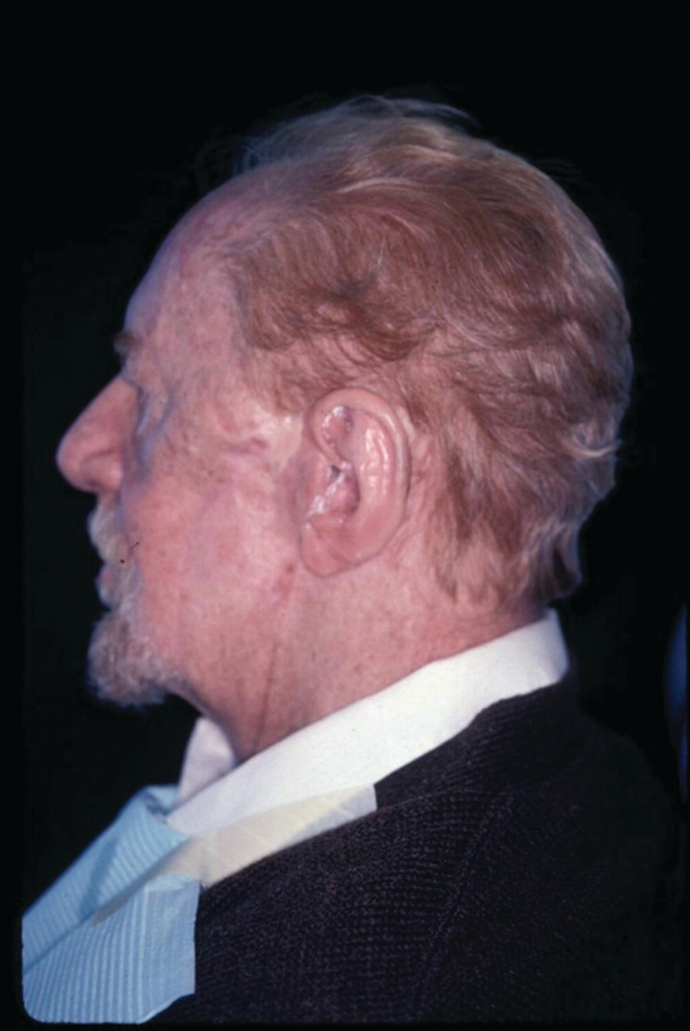 Photo displaying a patient wearing the auricular magnet-retained prosthesis after custom staining.