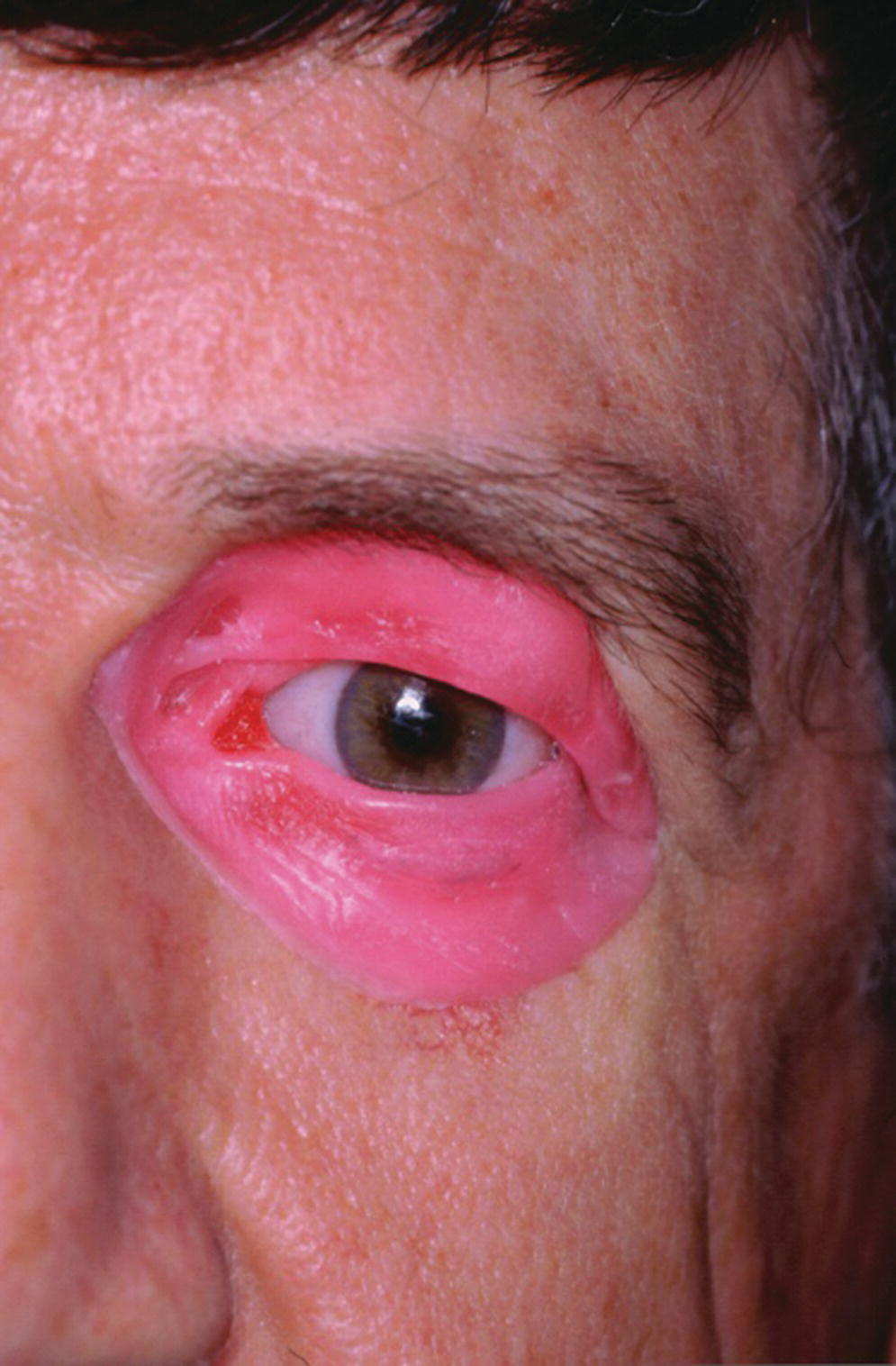 Photo of patient's left eye with surrounding area subjected to diagnostic waxing for presurgical planning.