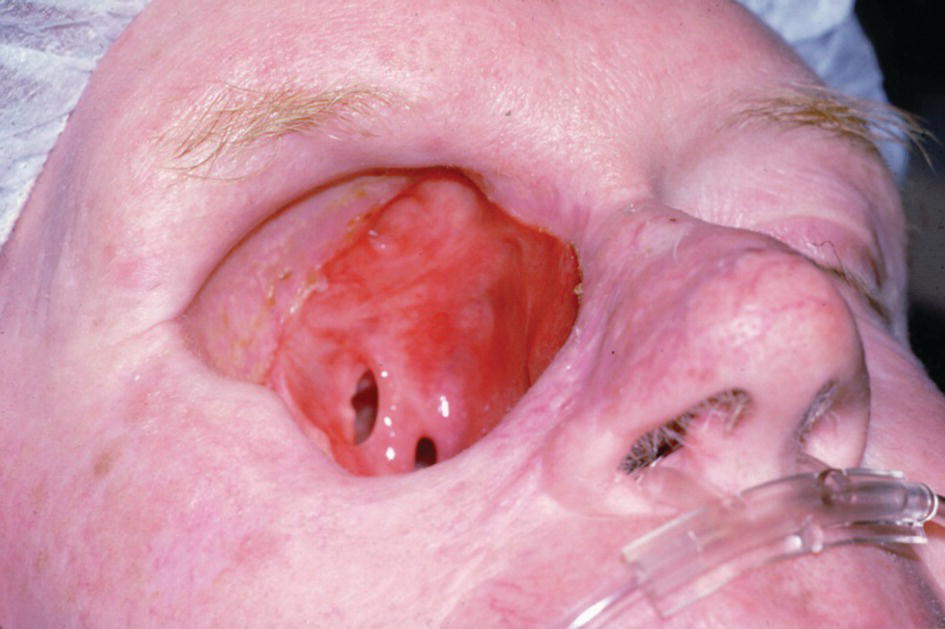 Photo of a patient with large orbital defect in the form of an empty cavity where the right eye should be.