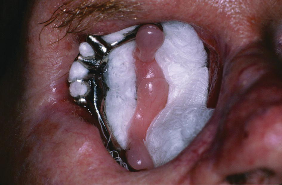 Photo of patient displaying the operated area which is attached to 4 IMZ implants placed to anchor a bar with magnets.