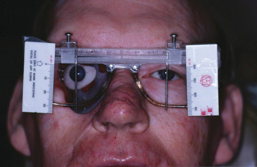Photo of patient displaying the positioning of the ocular prosthesis with a calibrated device.