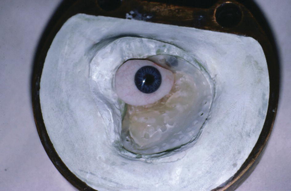 Photo of orbital prosthesis with magnet keeper as substructure.