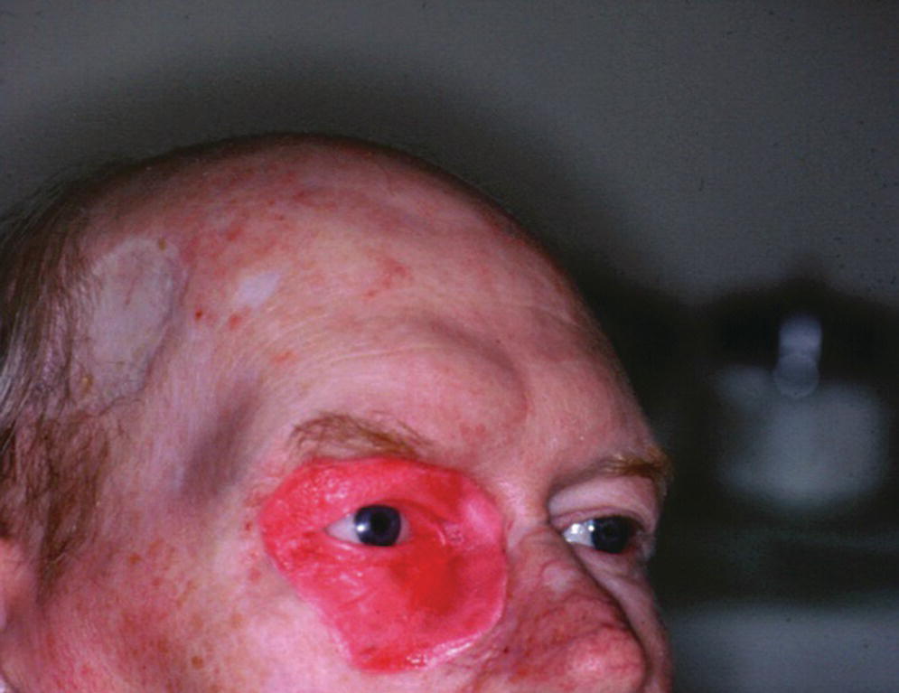 Photo of a patient applied with the wax trial of the orbital prosthesis.