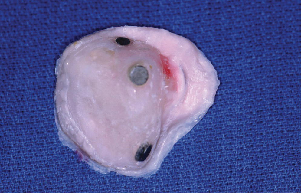 Photo of the magnet keeper (infrastructure) housed in the intaglio surface of the
orbital prosthesis.